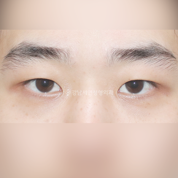 남자 눈성형 BEFORE