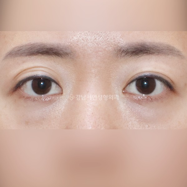 쌍꺼풀 악성 겹주름 해결 BEFORE