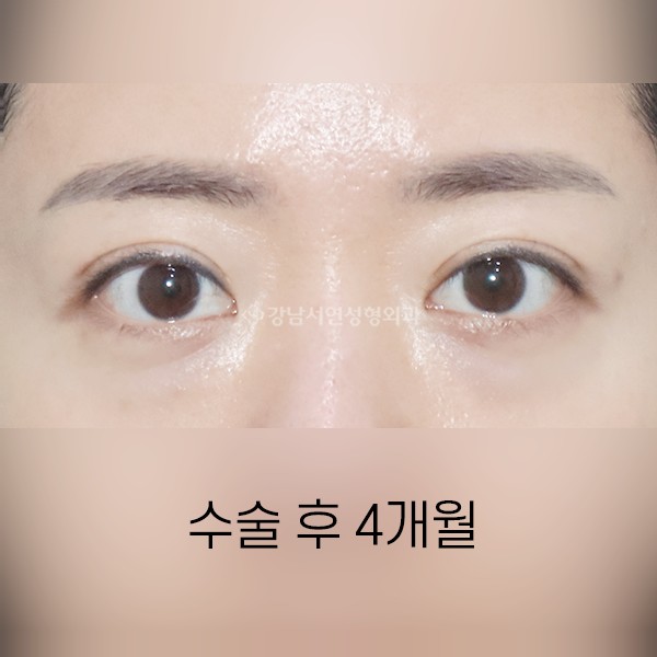 쌍꺼풀 악성 겹주름 해결 AFTER