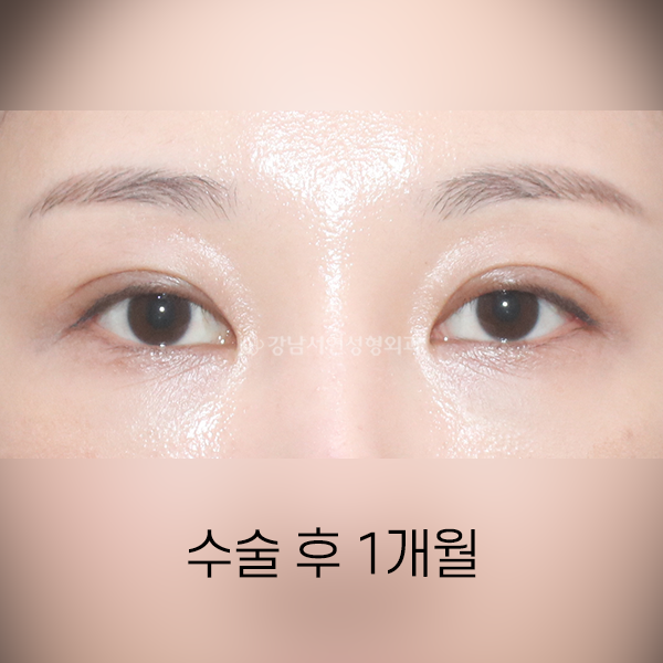 비대칭, 겹주름 개선 쌍꺼풀 재수술 AFTER