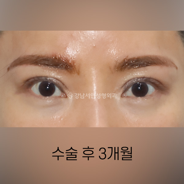퇴축수술 AFTER
