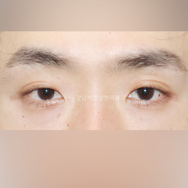 쌍꺼풀 라인 낮추기 1년 경과 BEFORE