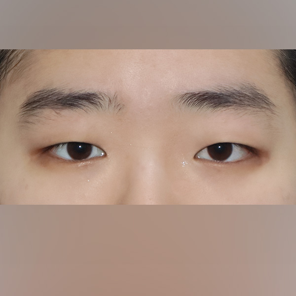절개눈매교정 + 앞트임 BEFORE