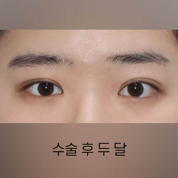 절개눈매교정 + 앞트임 AFTER