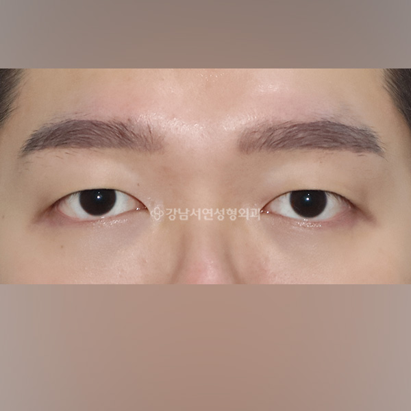 절개쌍꺼풀 BEFORE