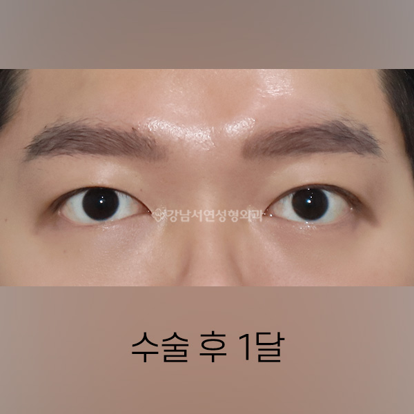 절개쌍꺼풀 AFTER