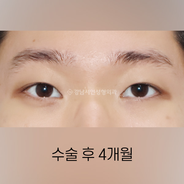 남자 두줄따기 속쌍꺼풀 낮추기 AFTER