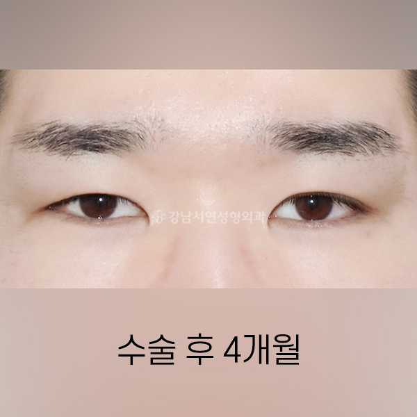 절개쌍꺼풀 + 뒤트임 + 밑트임 AFTER