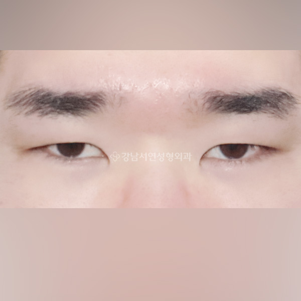 절개쌍꺼풀 + 뒤트임 + 밑트임 BEFORE