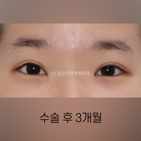 절개쌍꺼풀 + 앞트임 AFTER