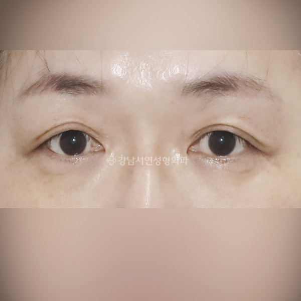 상안검 수술 처짐 해결 BEFORE