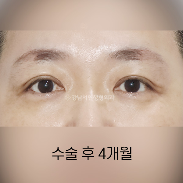 상안검 수술 처짐 해결 AFTER