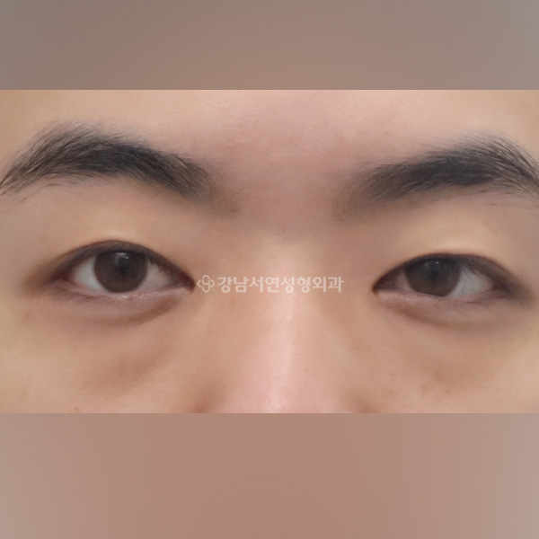 눈밑지방재배치 BEFORE