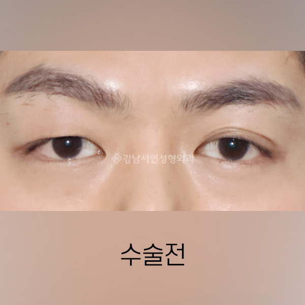 남자 쌍꺼풀 낮추기 BEFORE