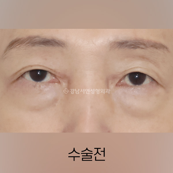 상안검 + 하안검 BEFORE