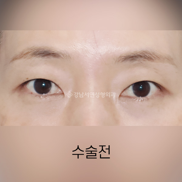 절개쌍꺼풀 BEFORE
