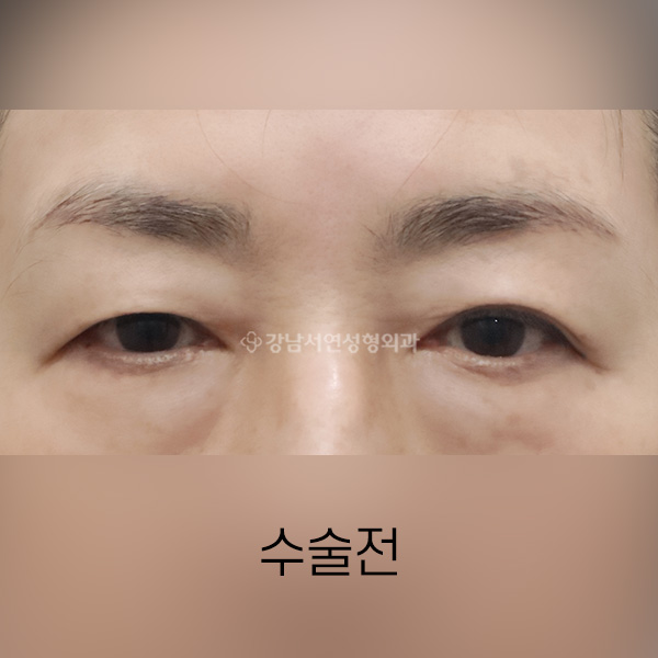상안검 + 눈밑지방재배치 BEFORE