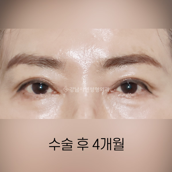 상안검 + 눈밑지방재배치 AFTER