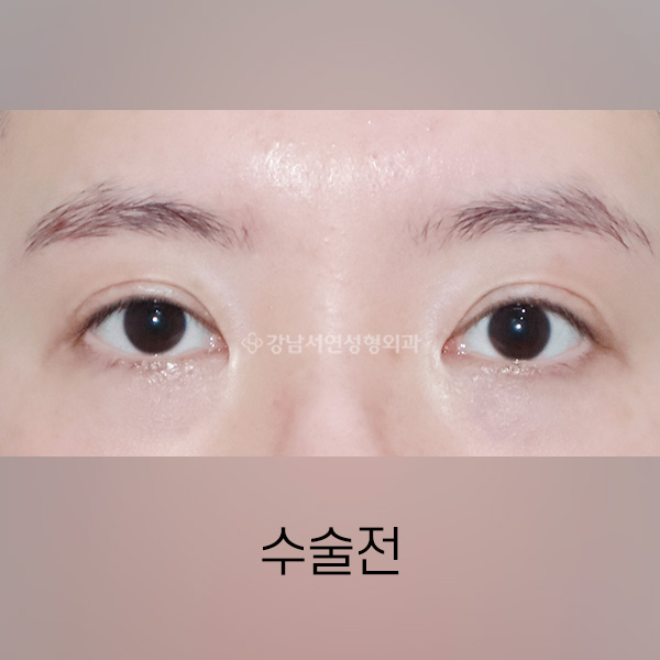 두줄따기 BEFORE