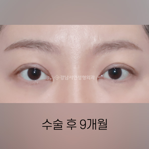 두줄따기 AFTER