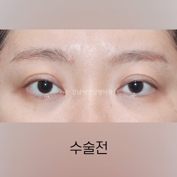 두줄따기 BEFORE