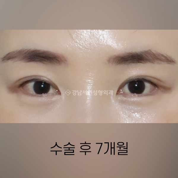뒤밑트임 AFTER