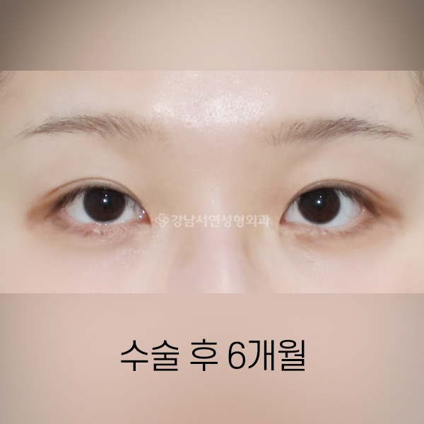 절개눈매교정 + 앞트임 AFTER