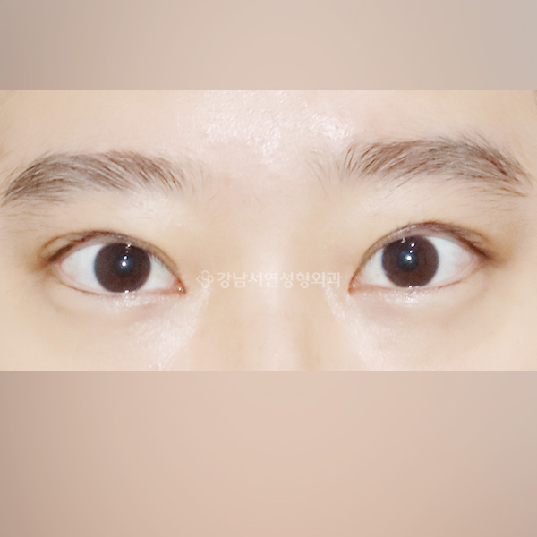 점막들림 라인교정 BEFORE