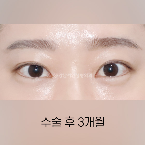 점막들림 라인교정 AFTER