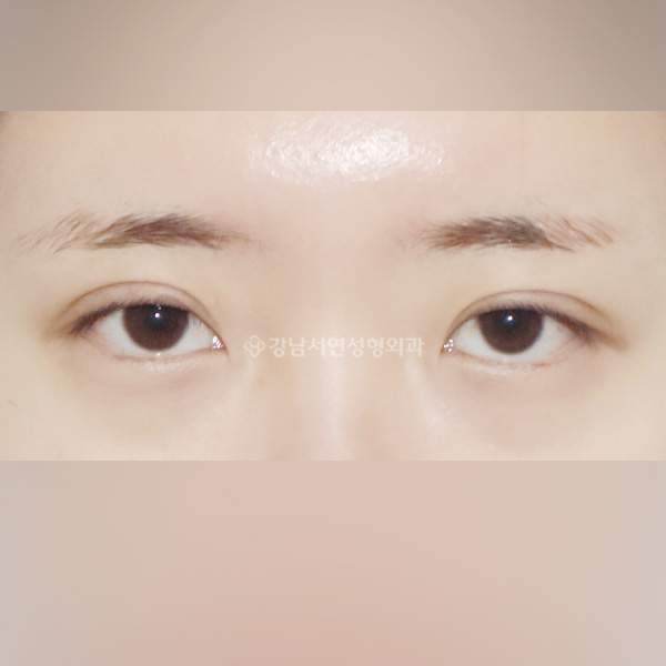 두줄따기 라인낮추기 BEFORE