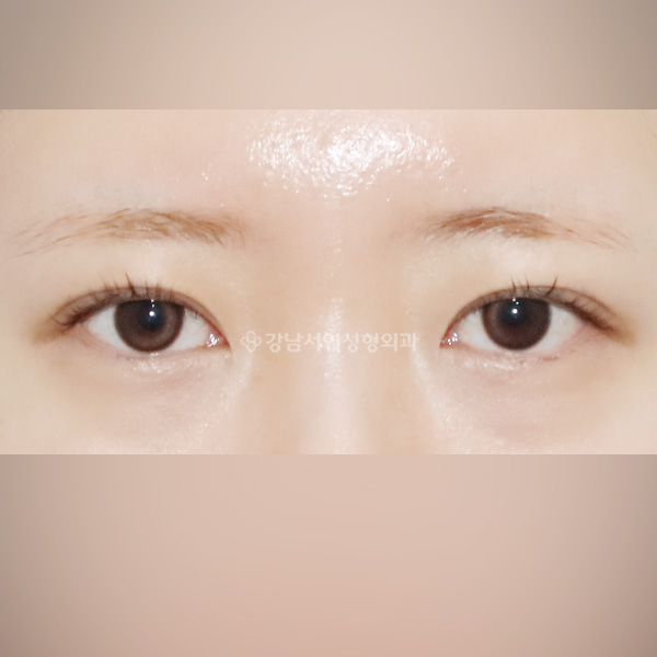 두줄따기 라인낮추기 AFTER