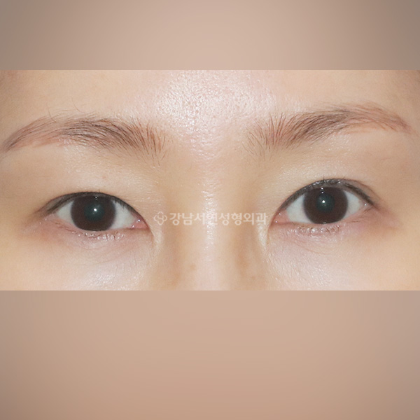 비대칭교정 BEFORE
