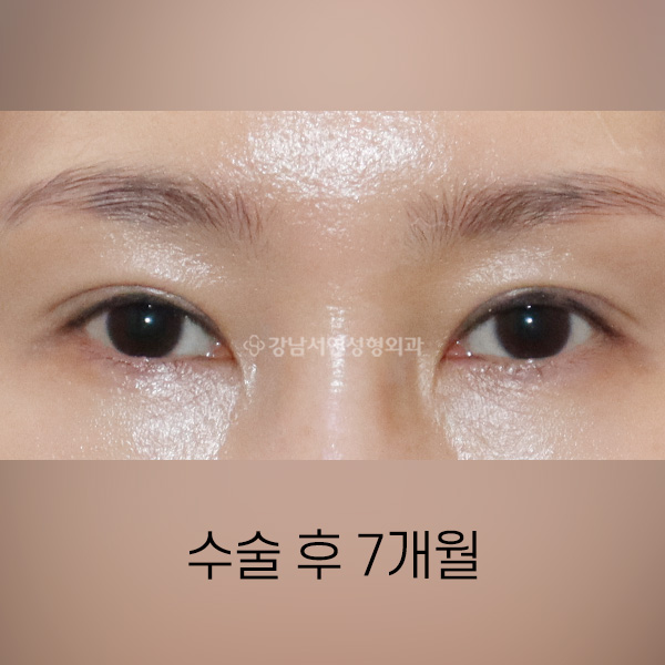 비대칭교정 AFTER