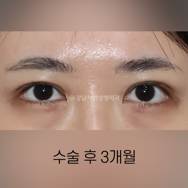 안검 퇴축수술 AFTER