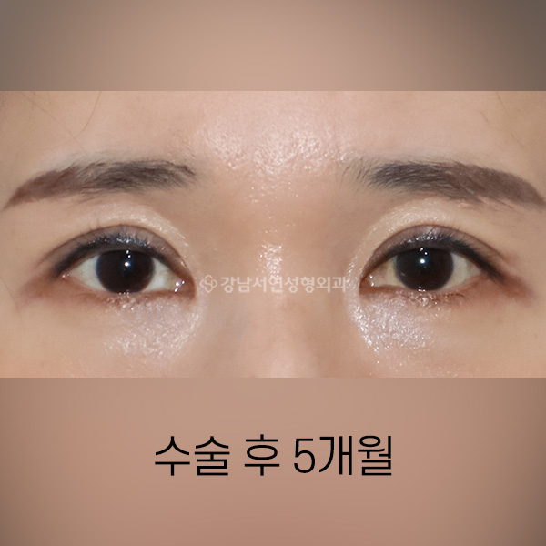 꺼진눈개선 AFTER