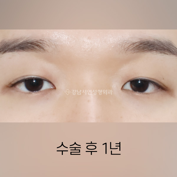 남자 라인낮추기 AFTER