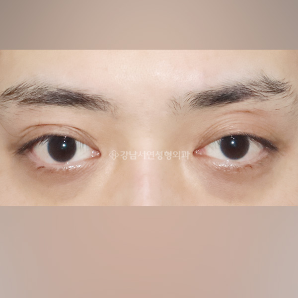라인낮추기 BEFORE