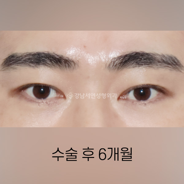 남자 쌍꺼풀 낮추기 AFTER