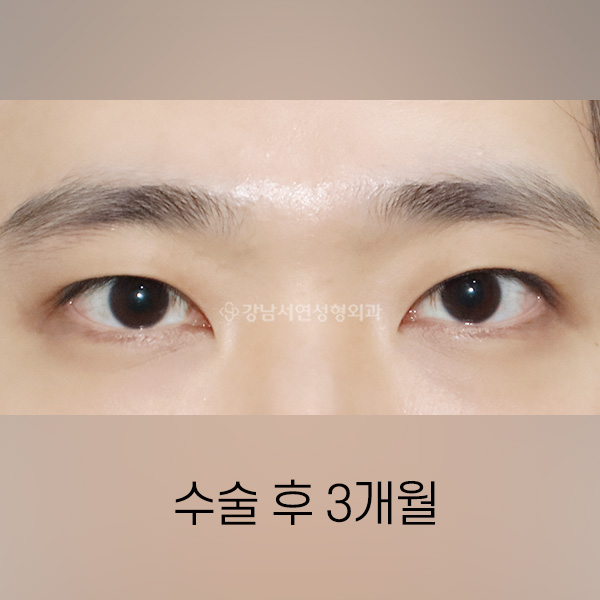남자 쌍꺼풀감추기 AFTER