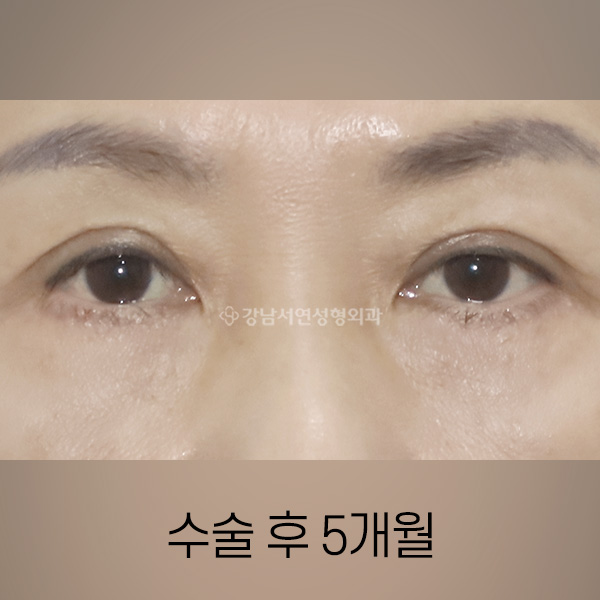 절개쌍꺼풀 + 하안검 재수술 AFTER
