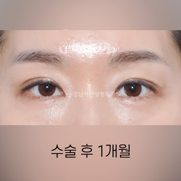 눈 위 지방이식 + 절개쌍꺼풀 재수술 AFTER