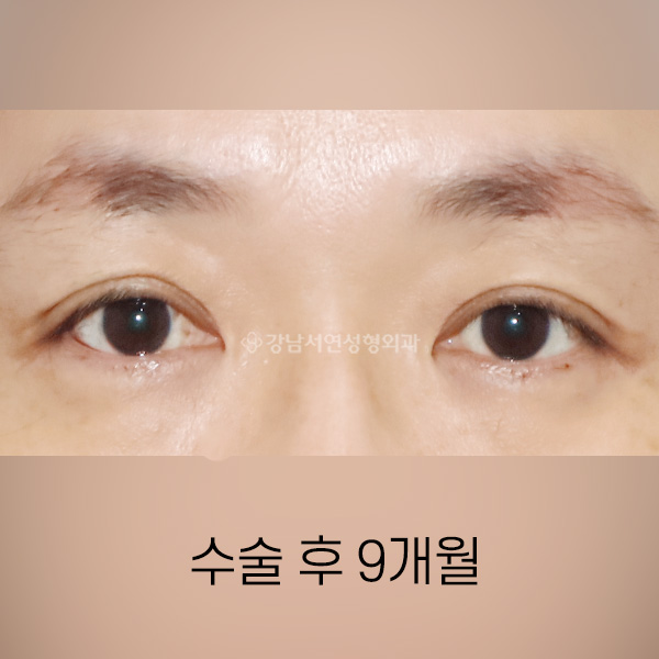 상안검 처짐개선 AFTER