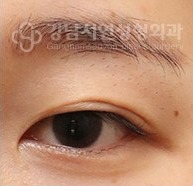 쌍꺼풀이 풀린 경우 BEFORE