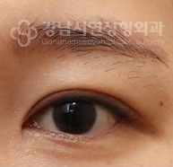 쌍꺼풀이 풀린 경우 AFTER