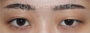 양쪽 쌍꺼풀이 비대칭인 경우 BEFORE
