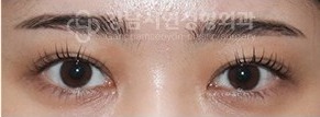 양쪽 쌍꺼풀이 비대칭인 경우 AFTER