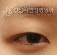 쌍꺼풀 라인이 너무 얇은 경우 BEFORE