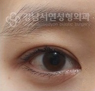 쌍꺼풀 라인이 너무 얇은 경우 AFTER