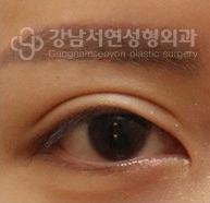 쌍꺼풀이 지나치게 두꺼운 경우 BEFORE
