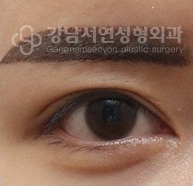 쌍꺼풀이 지나치게 두꺼운 경우 AFTER